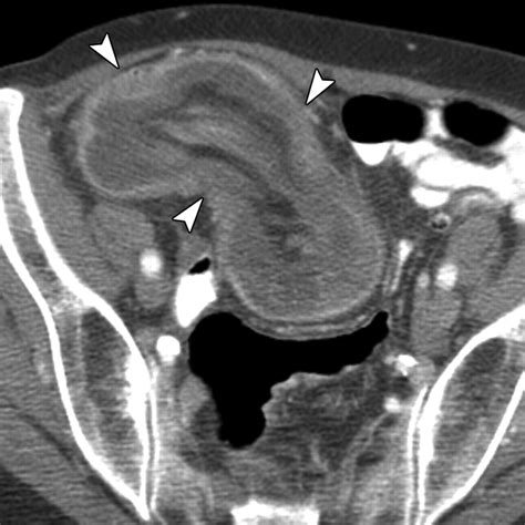 Ultrasound Imaging Of Bowel Pathology Technique And Keys To Diagnosis