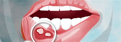 Afta - Dentysta.eu - Marcin Krufczyk