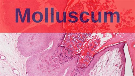 Molluscum Contagiosum Pathology Mini Tutorial Youtube