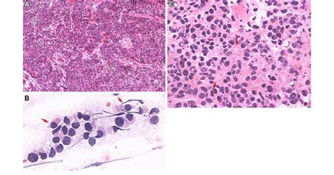 Frozen Section Shows A Cellular Tumor Forming Sheets And Vague Lobules