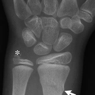 Salter Harris Type Ii Fracture In A Year Old Boy A Slightly