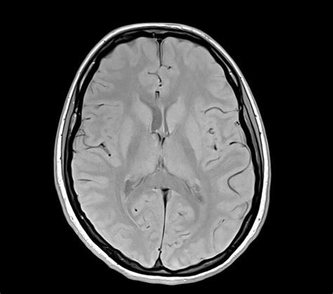 TR And TE In MRI TR Repetition Time TE Echo Time And Image Contrast