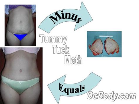 Tummy Tuck The Piece Of Tissue Removed Tummy Tucks Tummy Plastic Surgery