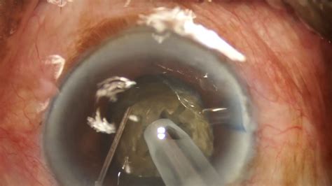 Seven Principles Of Phaco In Hard Cataract Dr Ramakrishna Tadanki