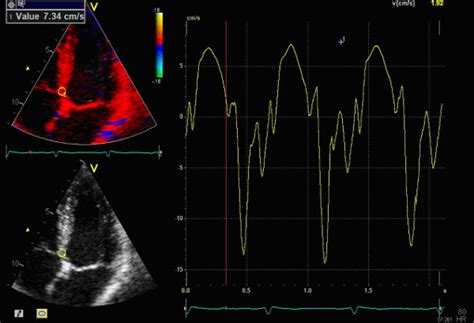 How The Peak Systolic Velocity Psv Information Is Acquired The Download Scientific Diagram