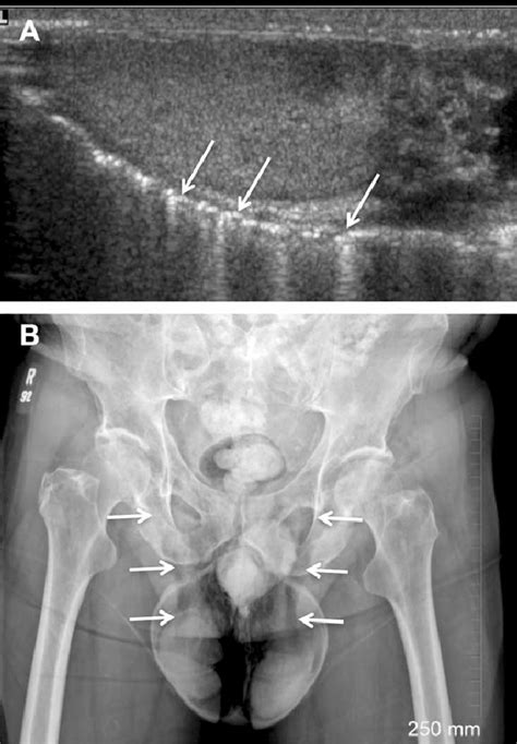 Air In The Scrotal Wall Extending From Subcutaneous Emphysema Of The