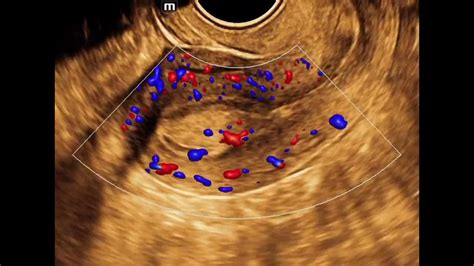 Endometrial Polyp Ultrasound Youtube