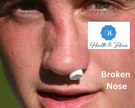 Broken Nose Unveiling The Hidden Challenges And Solutions