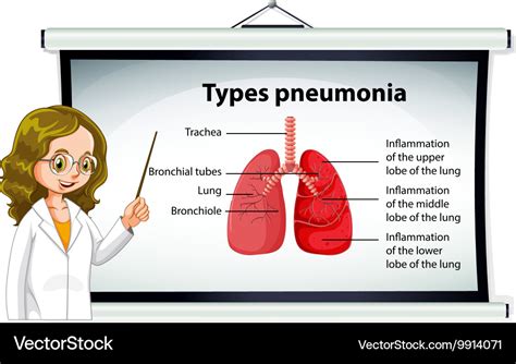 Doctor Explaining Types Of Pneumonia Royalty Free Vector