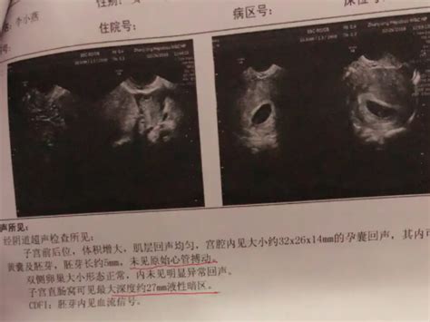 人工流产后肚子疼原因一览，警惕术后出血保护女性健康 柚鼠知识