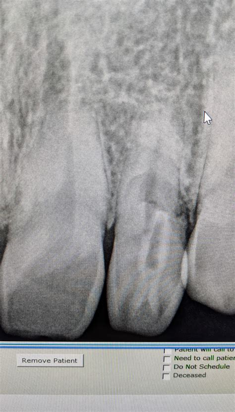 Dens in Dente : r/askdentists