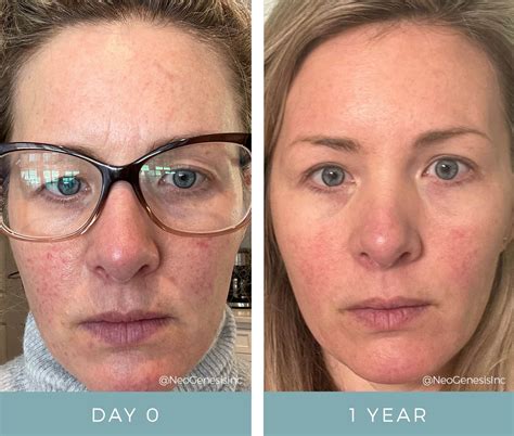 Before After Rosacea Neogenesis