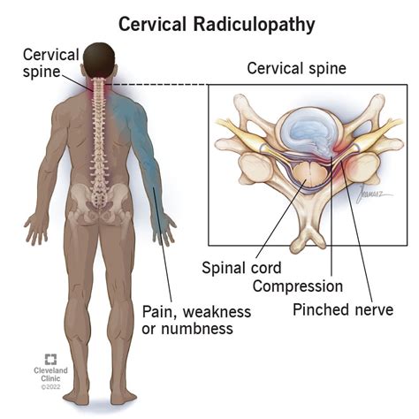 cervical radiculopathy exercises pdf nhs - Lawrence Bourgeois