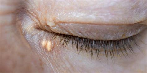 Xanthelasma Removal | London | Dr Elizabeth Hawkes