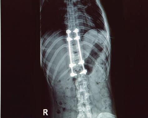 Spinal Implants And Surgical Devices Market Size Global Growth