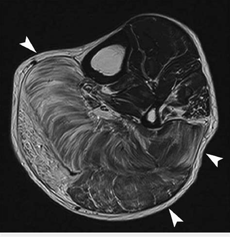 A Patient With Hereditary Advanced Limb Girdle Muscular Dystrophy And