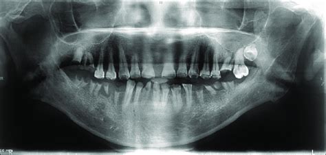 Orthopantomograph Showing Multiple Root Stumps And Midline Diastema