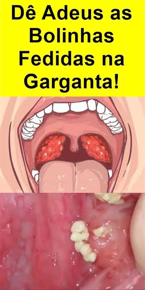 Como Tirar Bolinhas Brancas Da Garganta Caseum Artofit