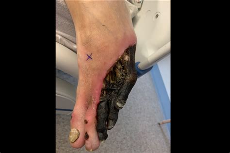 Ortho Dx Black Necrosis Of The Left Foot Clinical Advisor