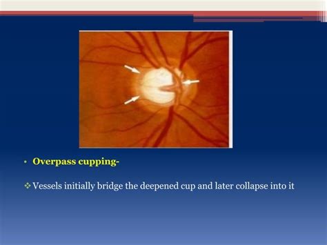 Glaucoma optic disc changes