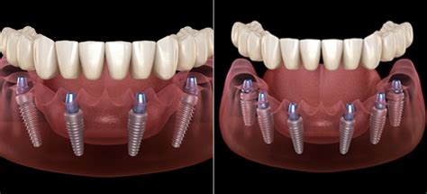 All On 4 Vs All On 6 Implants Choosing The Right Solution