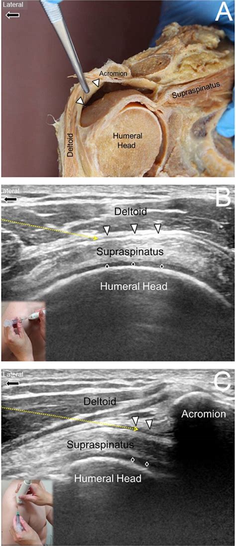 Shoulder Ultrasound Anatomy