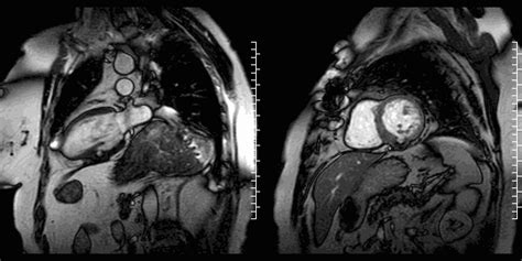 A Left Ventricular Pseudoaneurysm Before And After Surgical Correction