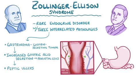 Zollinger-Ellison syndrome - Osmosis