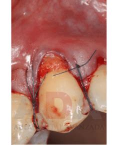 Recesiones gingivales múltiples y tunelización Aula Dental Avanzada