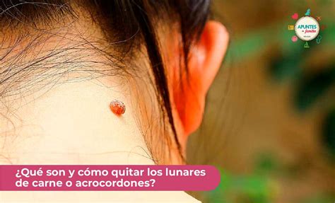 Qué son y cómo quitar los lunares de carne o acrocordones Revista