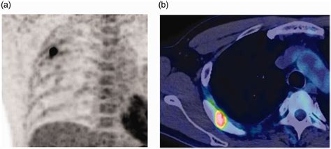 Osteoid Osteoma Of The Rib With Strong F 18 Fluoro Deoxyglucose Uptake Mimicking Osteoblastoma