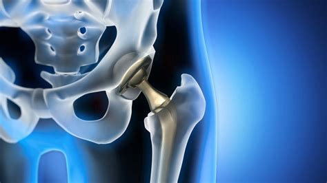 The Partial Hip Replacement Recovery Timeline - Orange County ...