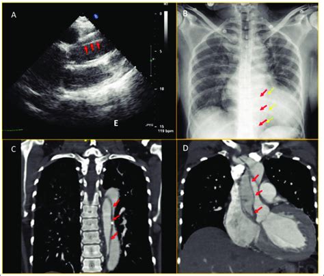 A Transthoracic Echocardiogram In Parasternal Long Axis View Showing