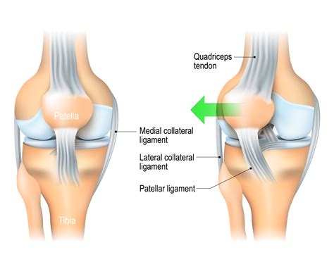 Patella Dislocation