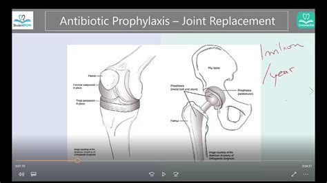 Antibiotic Prophylaxis Joint Replacement YES Or NO Answers Where