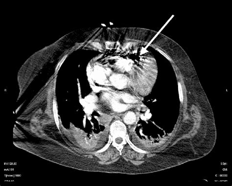 Air Embolus In The Right Atrium And Ventricle Download Scientific