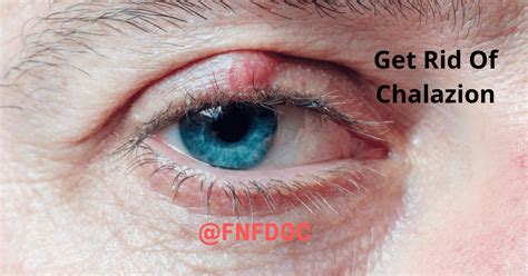 Get Rid Of Chalazion Dont Worry About Chalazion