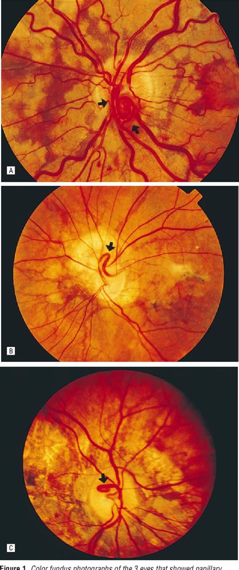 Figure 3 From Chorioretinal Vascular Abnormalities Associated With Angioid Streaks And