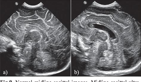 Neonatal Brain Ultrasound