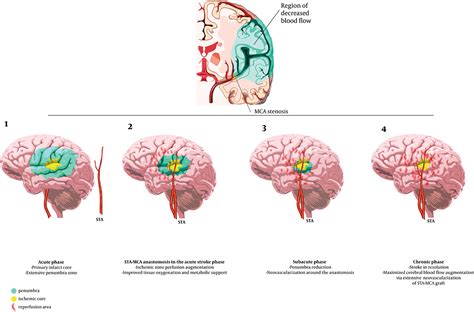 Mca Stroke Informacionpublica Svet Gob Gt