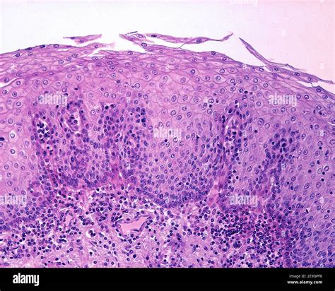 Epithelial Lining Of The Esophagus It Is A Non Keratinized Stratified