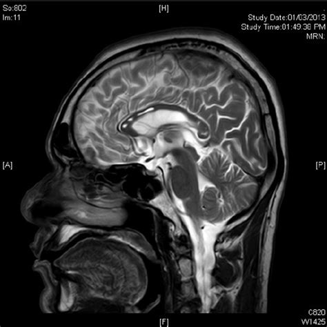 Mri Of Brain Sagittal View Revealed Multiple Focal Areas Of High T2