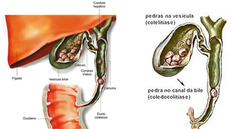 Cálculos Biliares Clínica do Aparelho Digestivo em Brasília