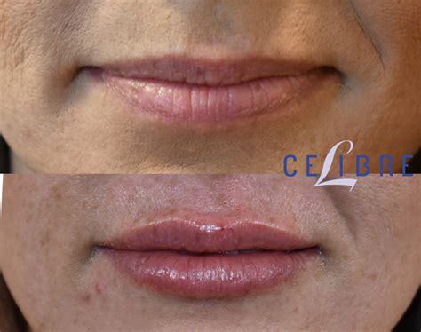 Before And After Photos Juvederm In Lipstick Alley | Lipstutorial.org