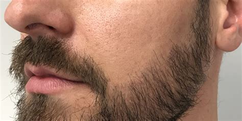 Facial Hair Transplant Asli Tarcan Clinic