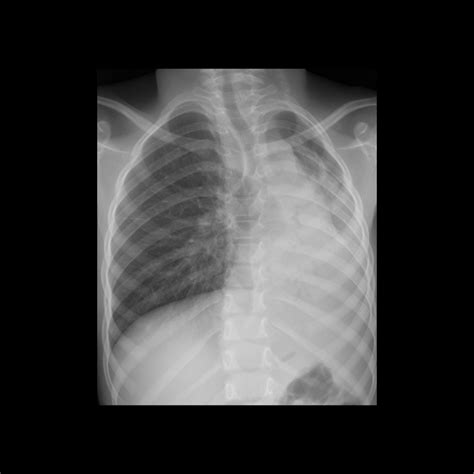 Pediatric Airway Foreign Body Pediatric Radiology Reference Article