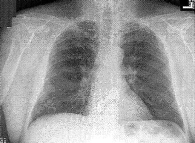 Chest X-Ray screening Ineffective against Lung Cancer