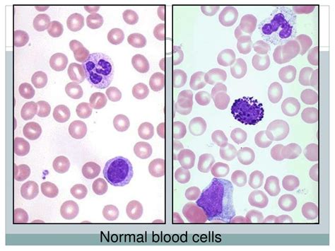 Ppt Macrocytic Anemia Powerpoint Presentation Free Download Id 3011826