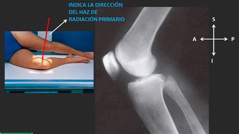 Escribir Una Carta Operaci N Posible Susteen Radiografia De Rodilla