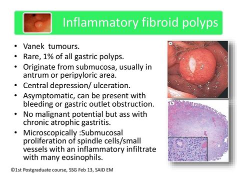 Management Of Gastric Polyps